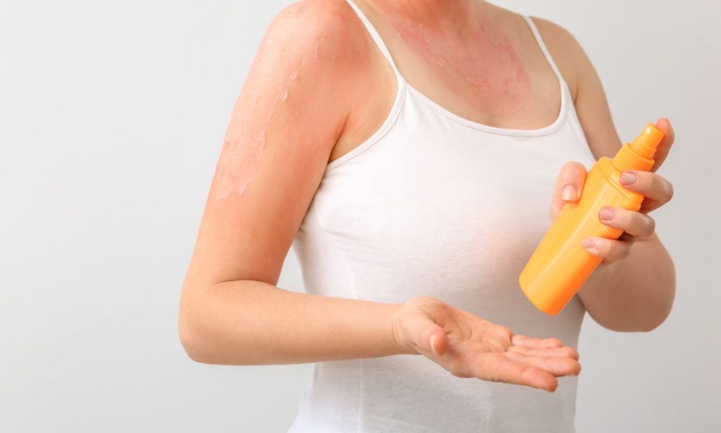 How to Apply Apple Cider Vinegar to Sunburn