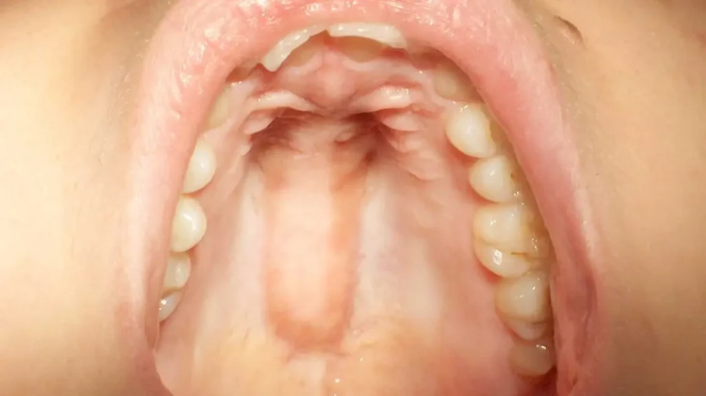 Why Is the Roof of My Mouth Swelling?