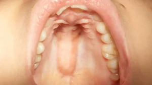 Why Is the Roof of My Mouth Swelling?